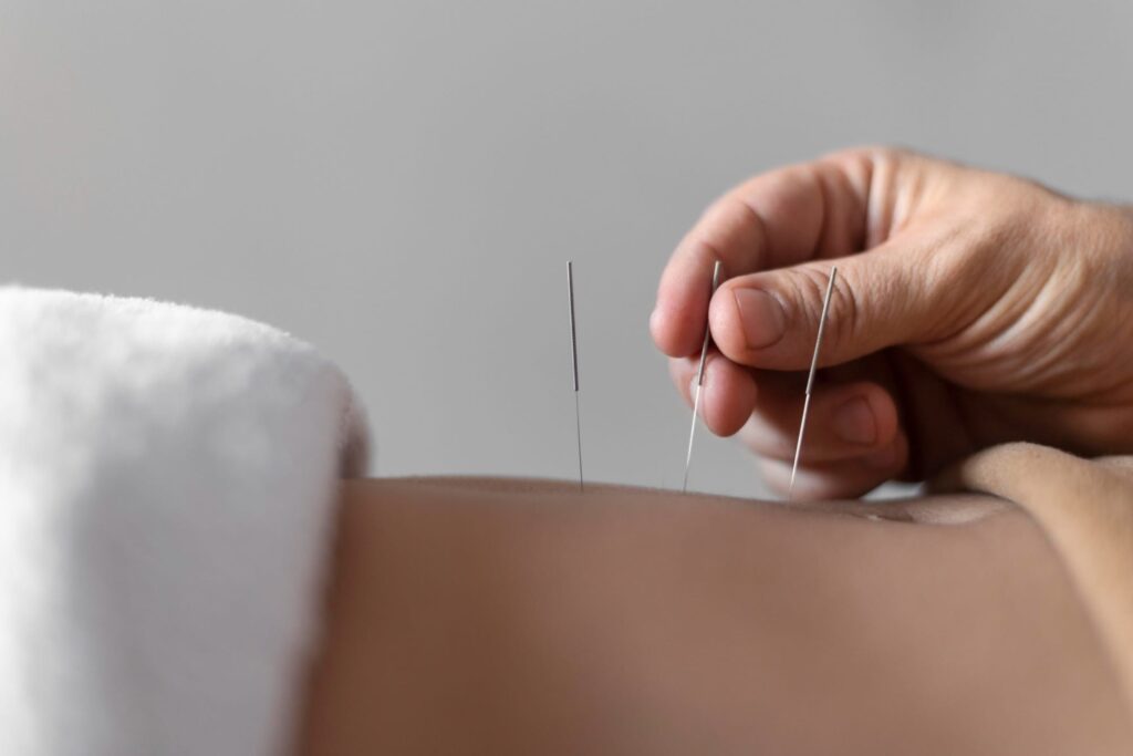 Acupuncture